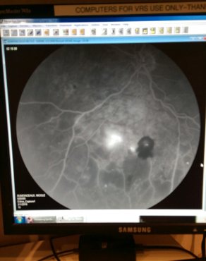 Diabetic eye